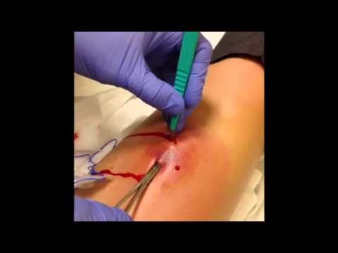 Incision and drainage with silicone loop
