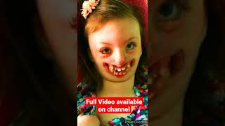 Type Of Syndrome, Cri Du Syndrome, Klinfilter Syndrome, Down Syndrome Patau Syndrome Turner Syndrome