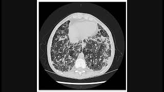 Pneumonia Vs. Pneumonitis - Medical Common Sense