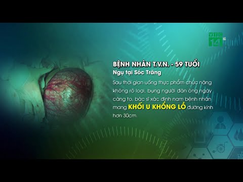 Người đàn ông bụng to bất thường vì uống thực phẩm chức năng | VTC14