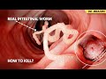 Pait Ke Keeron Ka Ilaj - Remove Intestinal Worms - Pinworms, Tapeworms, Hookworms - Urdu/Hindi