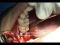 cirugía dental