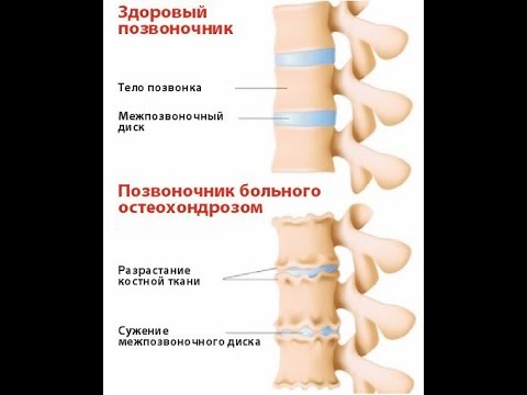 Как связан остеохондроз и всд Как связан остеохондроз и всд