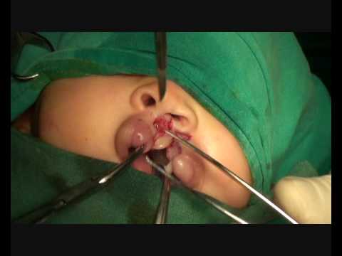 UNILATERAL CLEFT LIP REPAIR. 9:15. 4 mth old child with left incomplete 