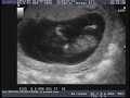 Our 12 Week Ultrasound Scan!!