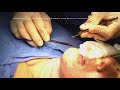 Neck Lift (Cervicoplasty) - Dr. Paul Ruff | West End Plastic Surgery
