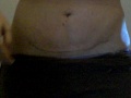 Mini tummy tuck before and after- Part 2