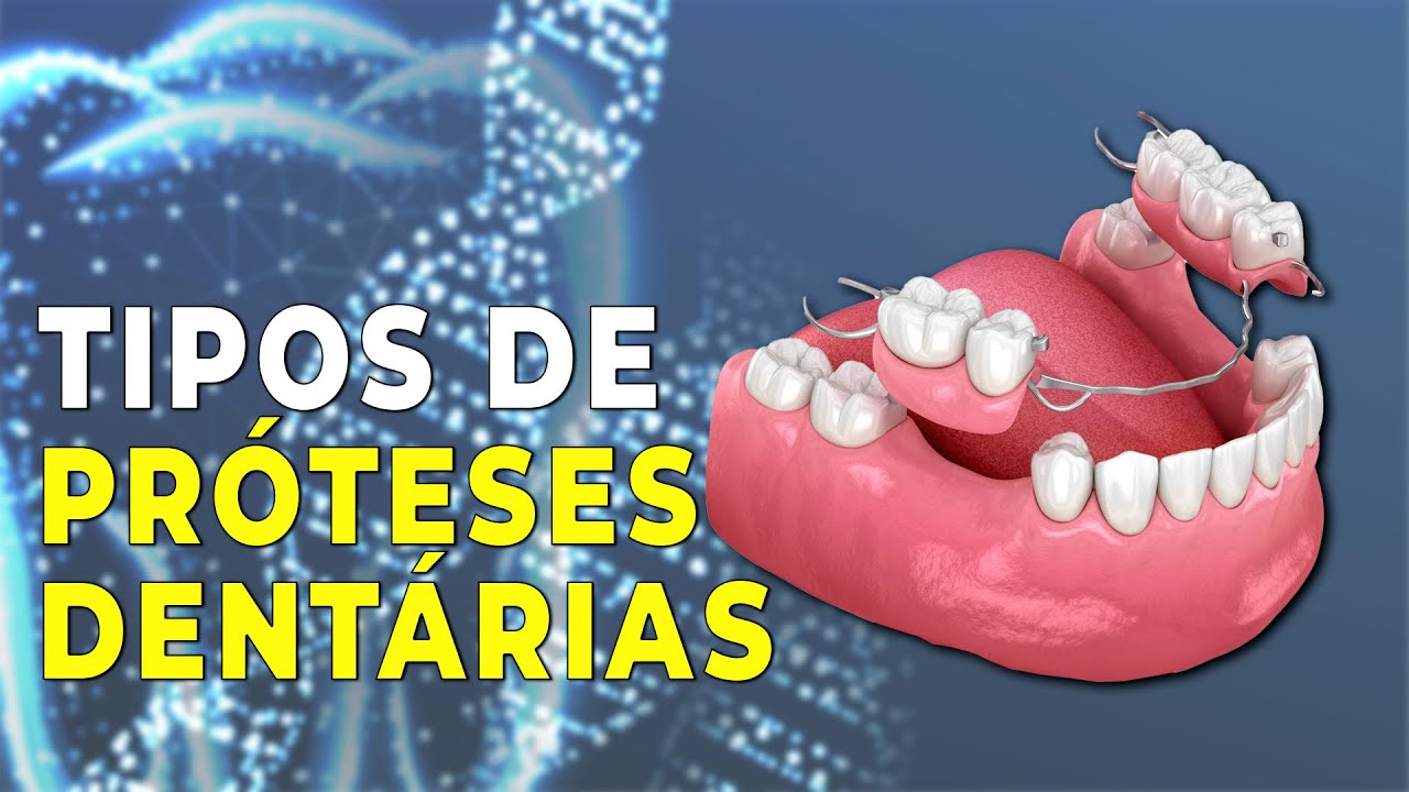 Fotos de proteses fixas dentarias 7 Fotos de proteses fixas dentarias 14