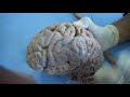 Cerebrum