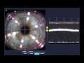 Stephen Slade MD Image Guided LASIK Flaps