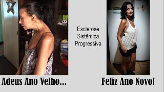 Adriana - Esclerose Sistêmica Progressiva - 1 ano de Vitamina D