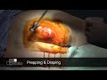Incision & drainage of abscess " gluteal "