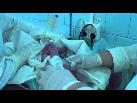 Роды при тройном обвитии Роды при тройном обвитии