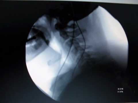 My Modified Barium Swallow Test - YouTube