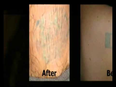 Tattoo Removal Cream - YouTube