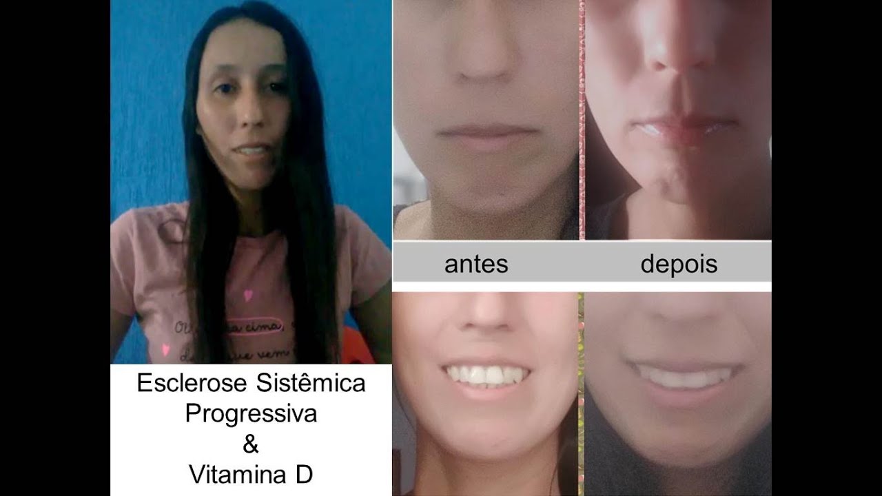 Tatiana - Esclerose Sistêmica Progressiva