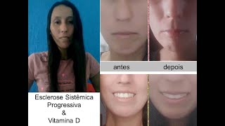 Tatiana - Esclerose Sistêmica Progressiva
