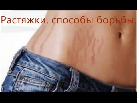 Растяжки на коже на боку Растяжки на коже на боку