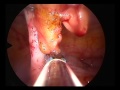 single trocar 10 mm incision laparoscopic appendicectomy.mpg