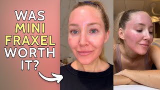 I Had A Mini Fraxel - Was It Worth It??