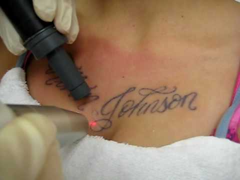 Laser Tattoo Removal by Medispa Institute in Houston, TX.