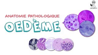 Anatomie Pathologique - Loedème