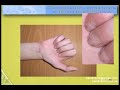 Video FLEXOR TENDONS