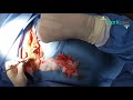 Mini Tummy Tuck - The Park Clinic for Plastic Surgery