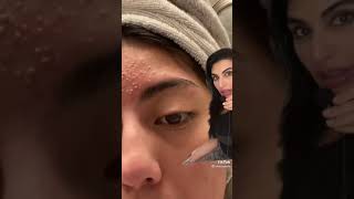 Pustular Acne