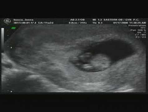 Ultrasound, Sonogram 11 weeks