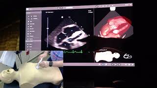 Echo case - "Vacation dyspnea" - Basic Echocardiogram - Dr Jamal USMLE