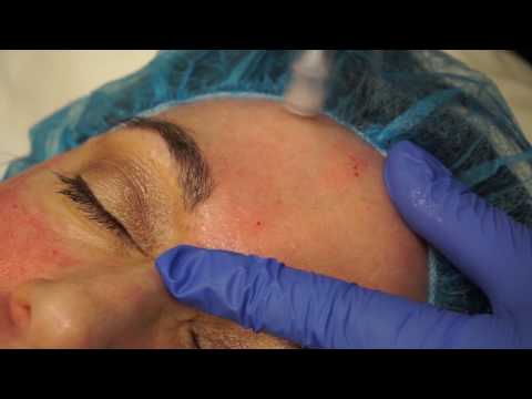Microneedling at Austin Plastic Surgery Institute & Skin Care Clinic