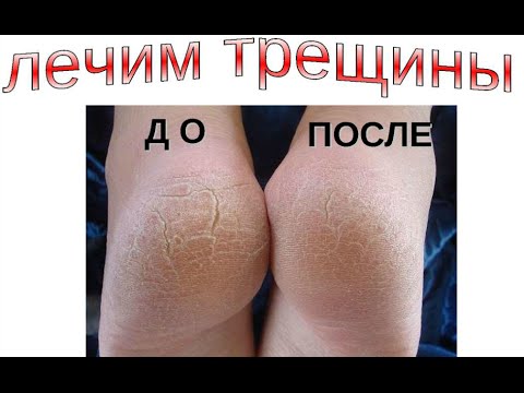 Почему трескаются пятки и как лечить трещины Почему трескаются пятки и как лечить трещины