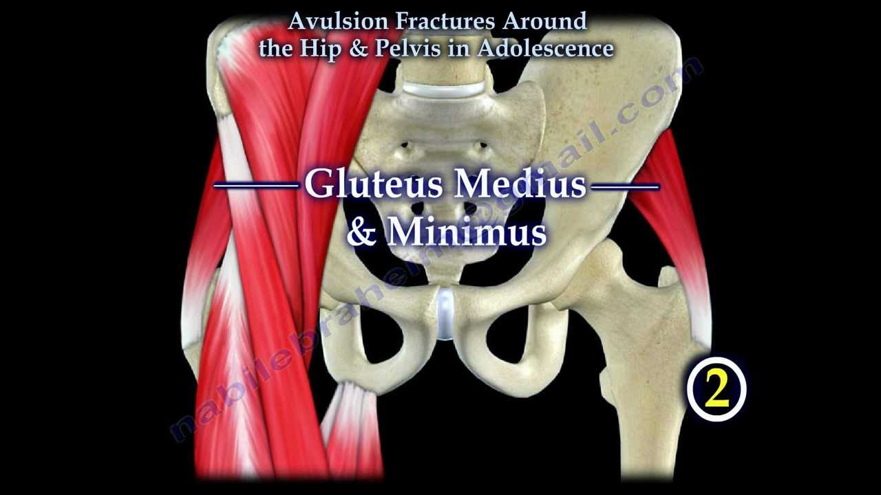 Avulsion Fractures Around The Hip In Adolescence - Everything You Need