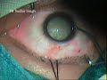 Topical Small Incision Cataract Surgery (SICS) In White Cataracts By Dr Sudhir Singh