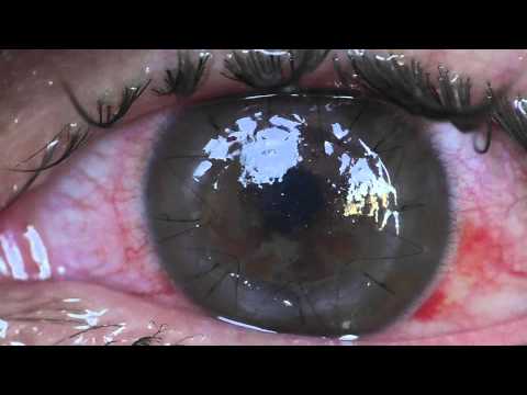 Off-Topic: Stitches of corneal graft / transplant - Incredible!