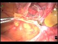 hernioplastia