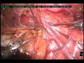 hernioplastia