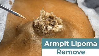 Asmr Huge Blackhead Most Satisfying Removal, Skincare Transformation Dr. Pimple Popper 1210M3 0731