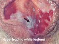 Vulva Lichen planus