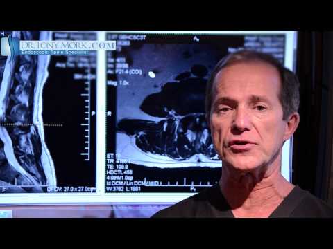 Adjacent Disc Disease After Lumbar Fusion by Dr. Tony Mork