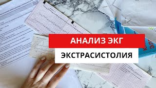 Экстрасистолия. Экг Диагностика. (Наджелудочковая И Желудочковая Экстрасистолии).