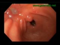 A Gastric Prepyloric Benign Ulcer