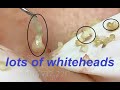 #14 #loannguyen- lấy mụn ẩn - The_TRUTH HURT_with remove acne?_
