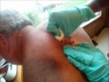 Huge Cyst Extraction images Huge Cyst Extraction