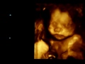 3D ultrasound experience