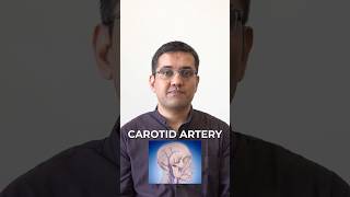 Treatment For Carotid Artery Issues