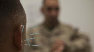 Using Acupuncture on Marines in War