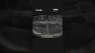 All-On-X Implant Treatment For Severely Atrophied Mandibular Ridge