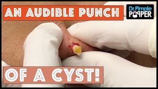 A truly AUDIBLE punch of a cyst! A truly AUDIBLE punch of a cyst!